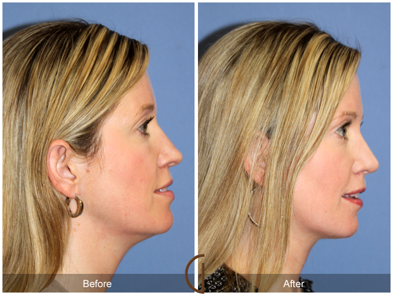 Female Rhinoplasty Before & After Image