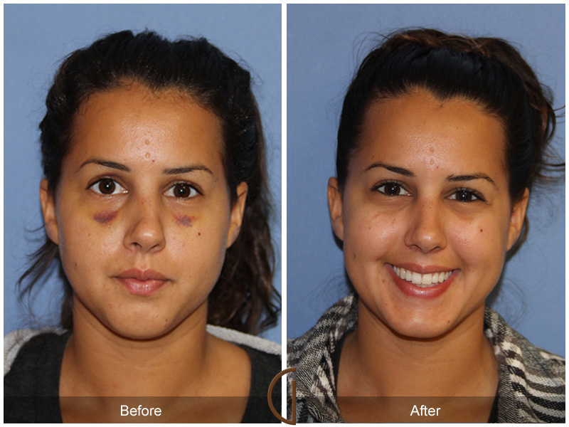 Female Rhinoplasty Before & After Image