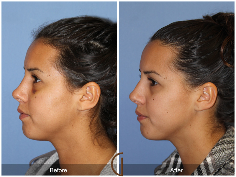 Female Rhinoplasty Before & After Image