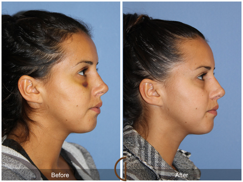 Female Rhinoplasty Before & After Image