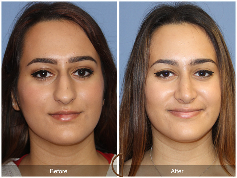 Female Rhinoplasty Before & After Image