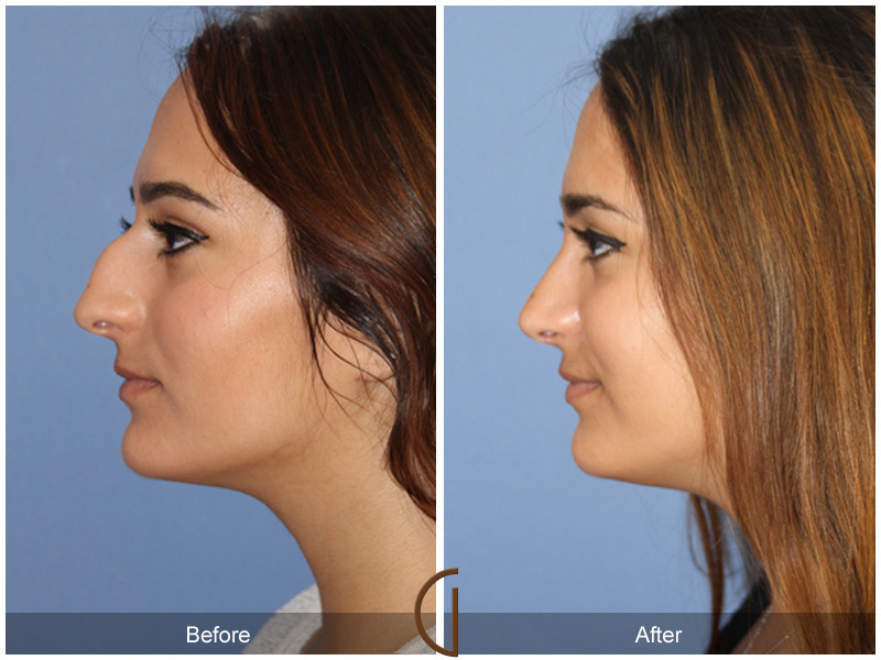 Female Rhinoplasty Before & After Image