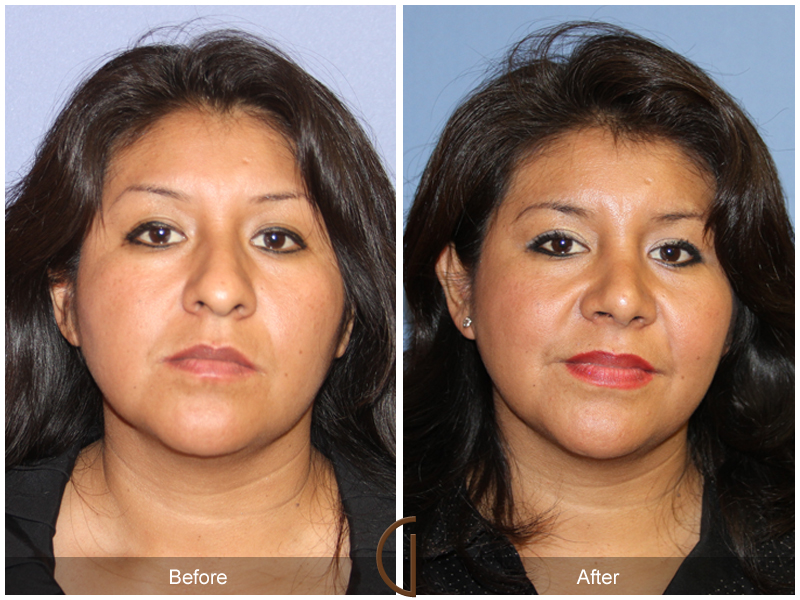 Female Rhinoplasty Before & After Image