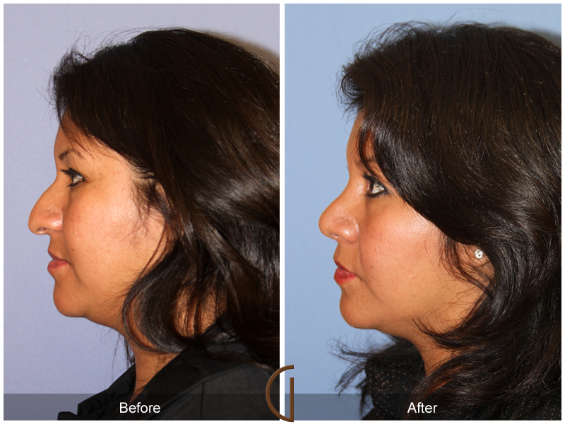 Female Rhinoplasty Before & After Image