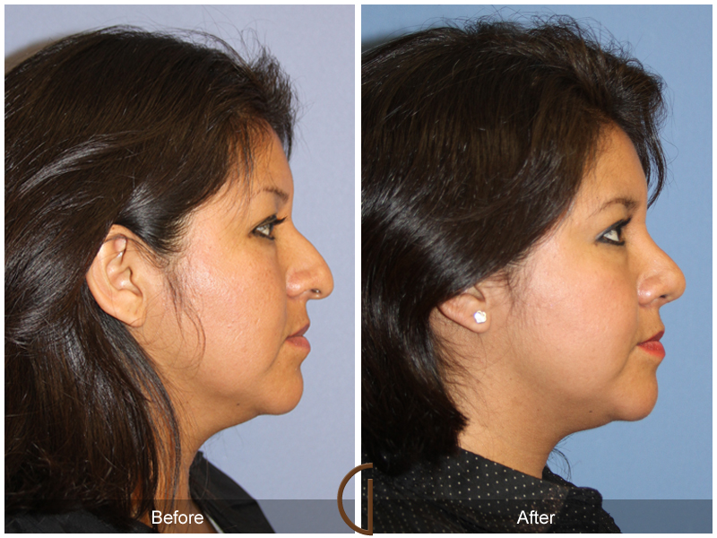 Female Rhinoplasty Before & After Image