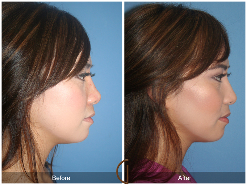 Female Rhinoplasty Before & After Image