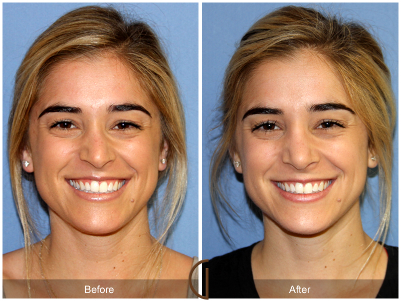 Female Rhinoplasty Before & After Image