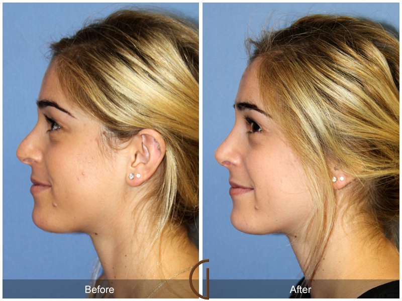 Female Rhinoplasty Before & After Image