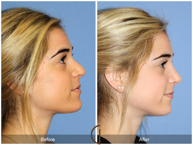 Female Rhinoplasty Before & After Image