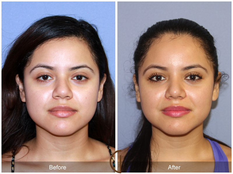 Female Rhinoplasty Before & After Image