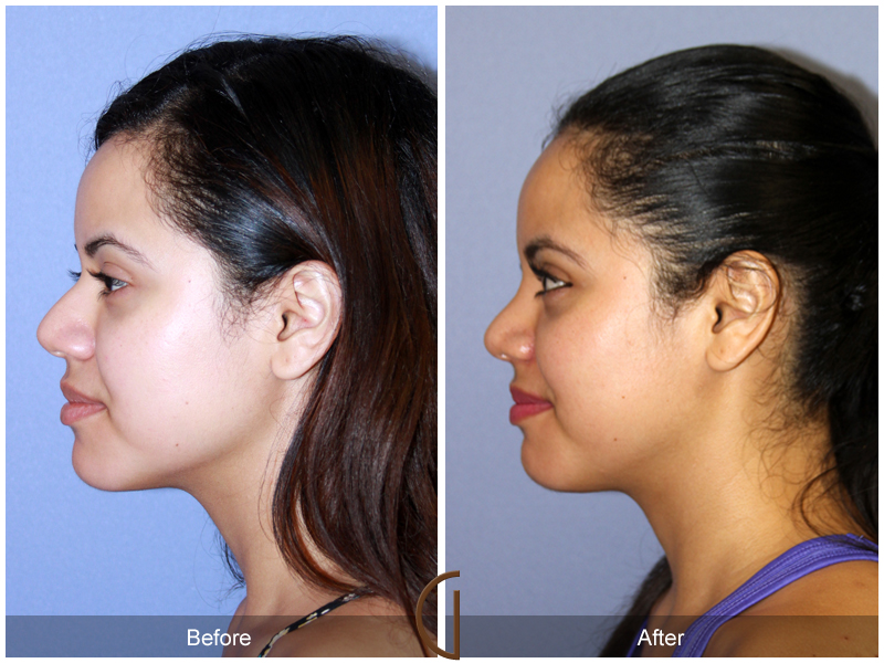 Female Rhinoplasty Before & After Image