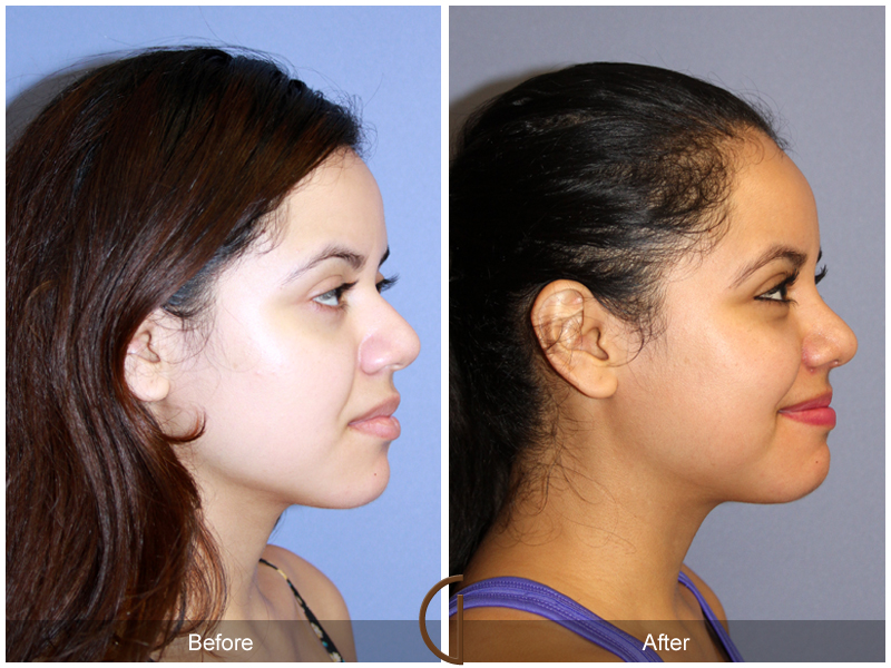 Female Rhinoplasty Before & After Image