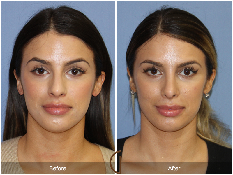 Female Rhinoplasty Before & After Image