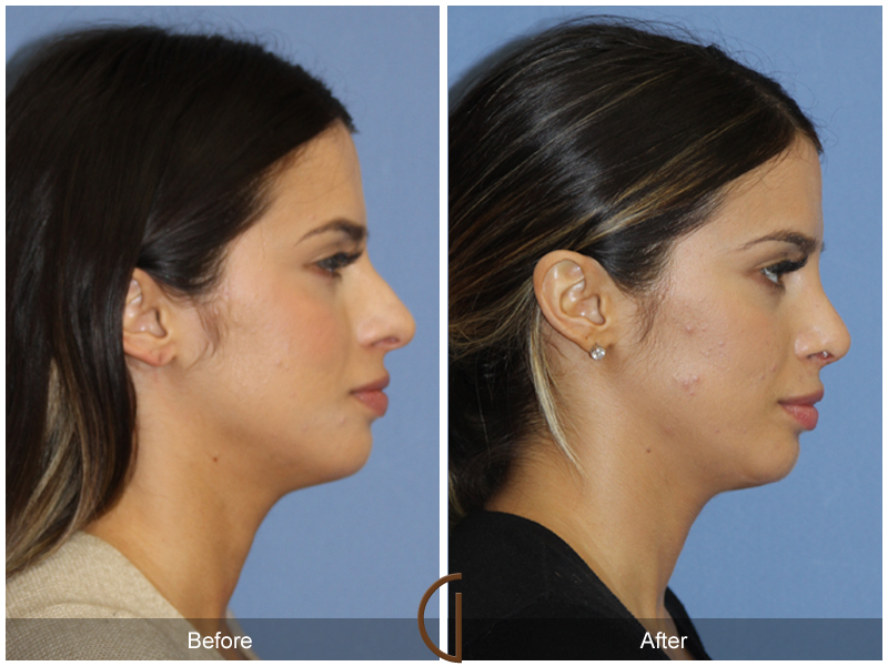 Female Rhinoplasty Before & After Image