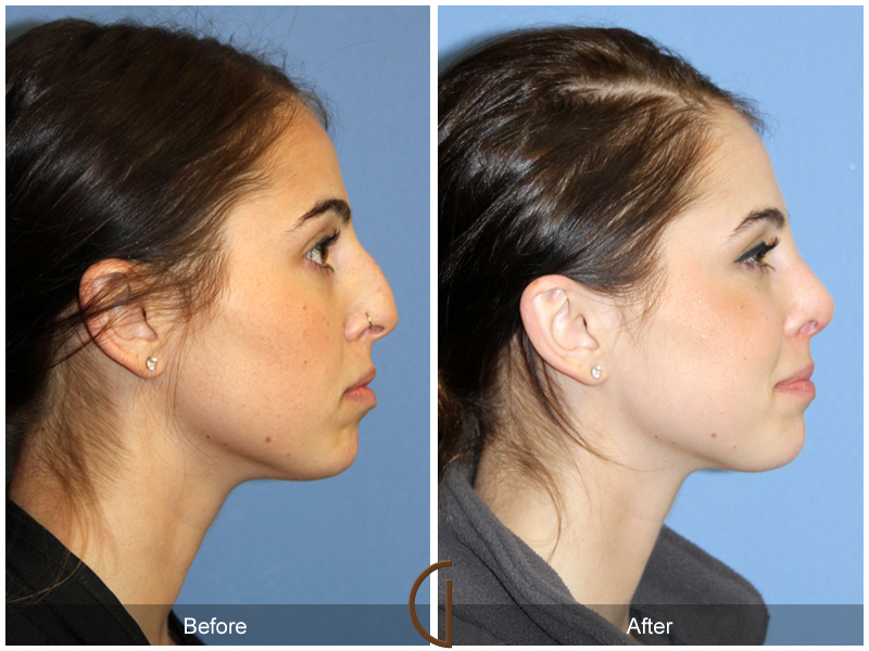 Female Rhinoplasty Before & After Image