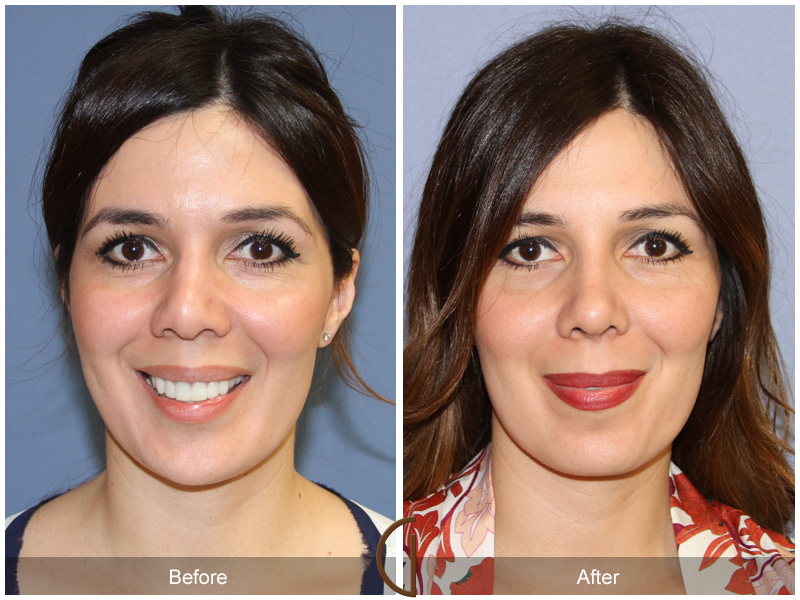 Female Rhinoplasty Before & After Image