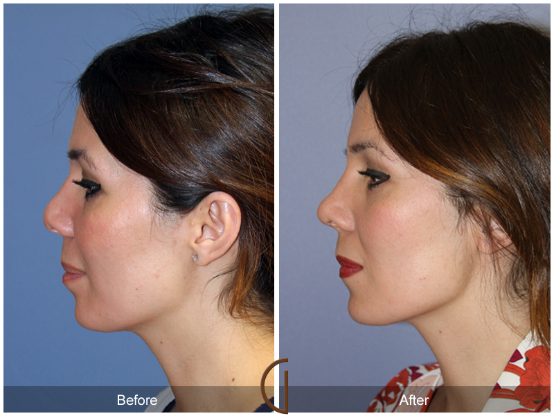 Female Rhinoplasty Before & After Image