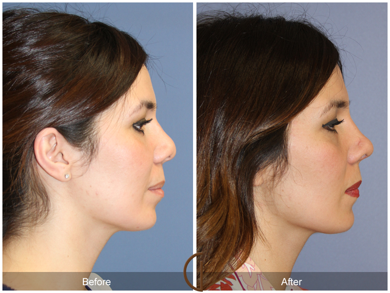 Female Rhinoplasty Before & After Image