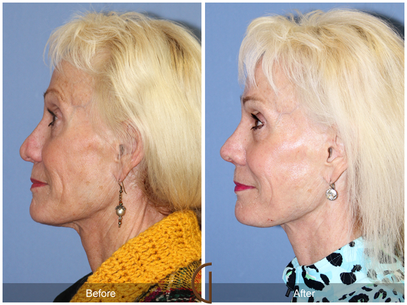 Female Rhinoplasty Before & After Image