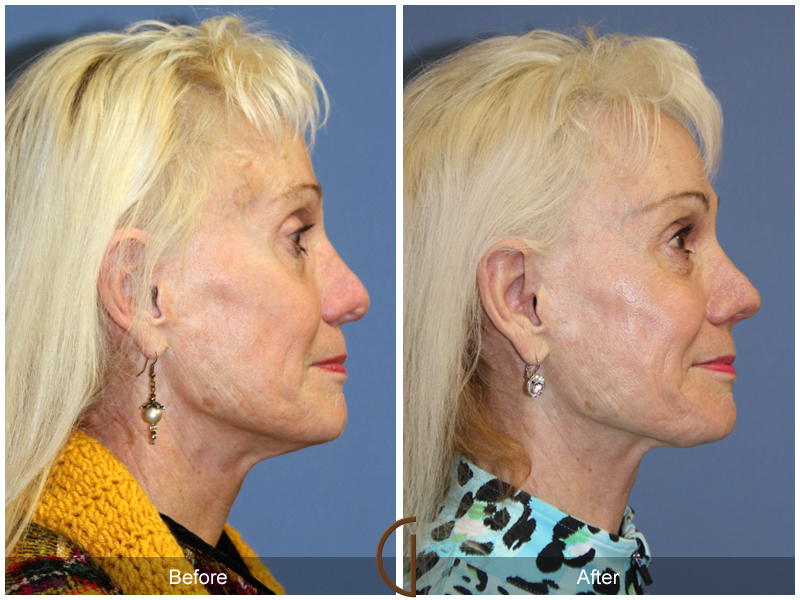 Female Rhinoplasty Before & After Image