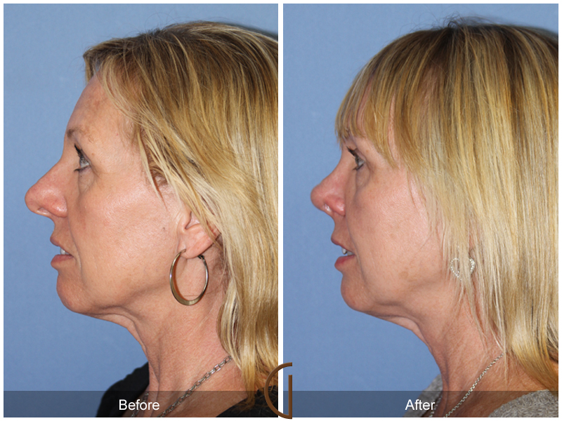 Female Rhinoplasty Before & After Image