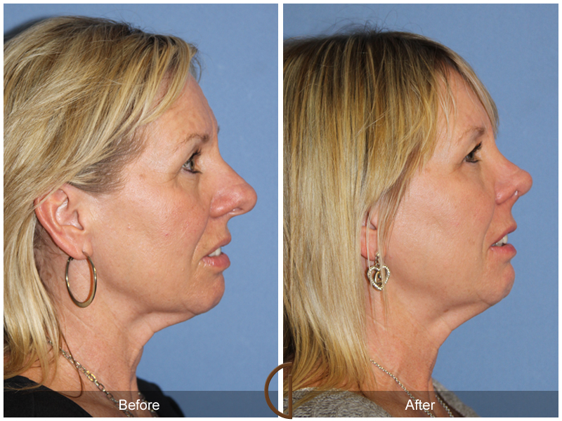 Female Rhinoplasty Before & After Image