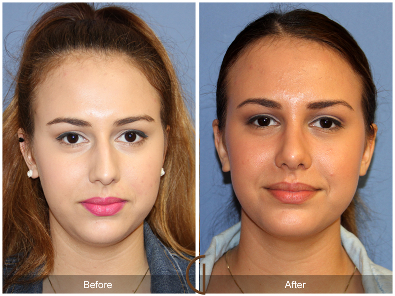 Female Rhinoplasty Before & After Image