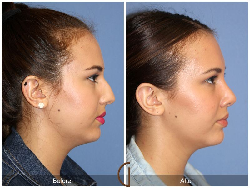 Female Rhinoplasty Before & After Image