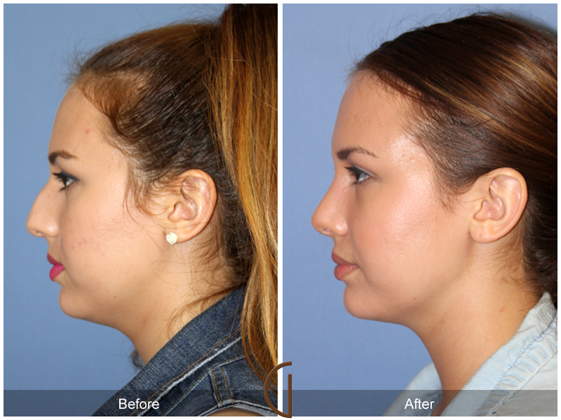 Female Rhinoplasty Before & After Image