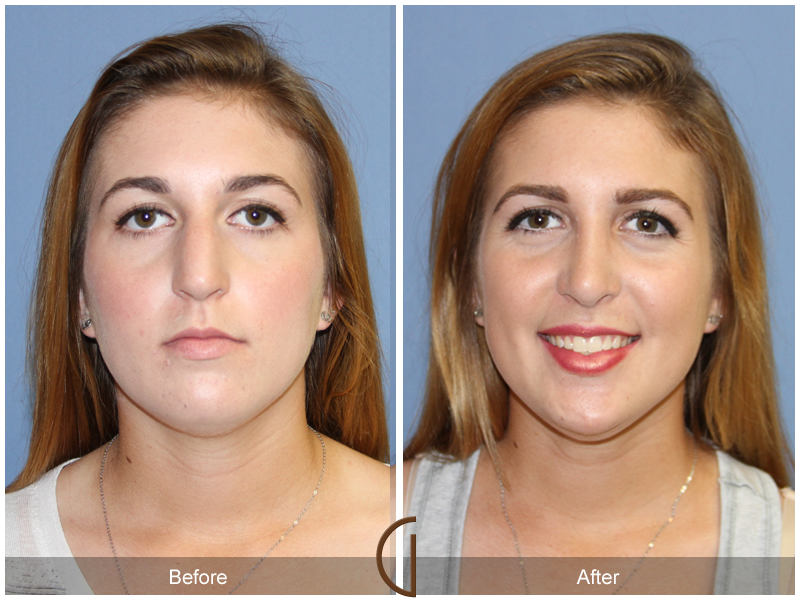 Female Rhinoplasty Before & After Image