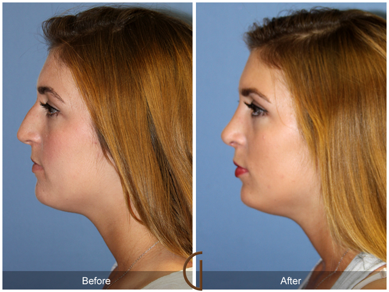 Female Rhinoplasty Before & After Image