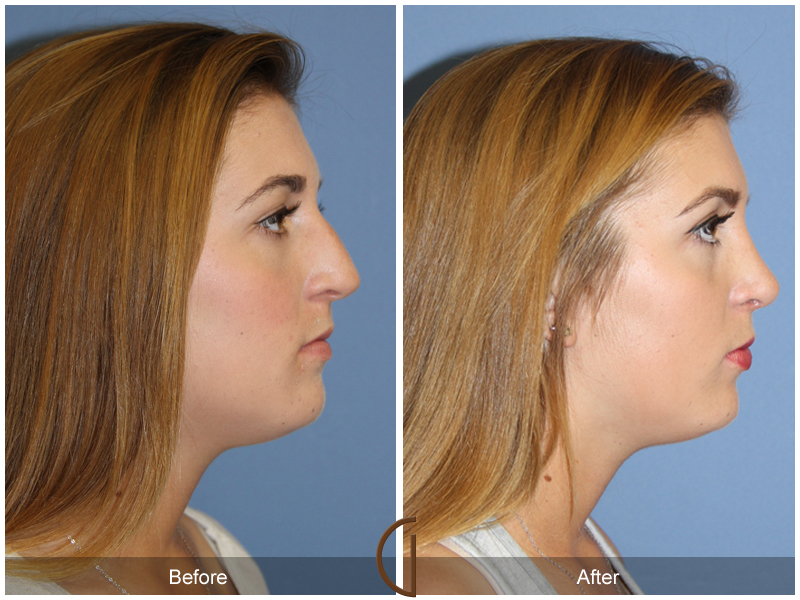 Female Rhinoplasty Before & After Image