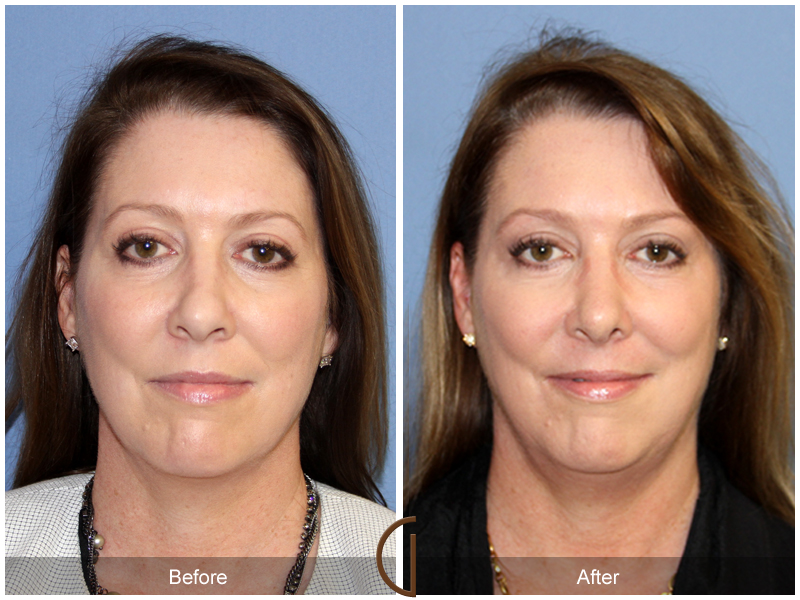 Female Rhinoplasty Before & After Image