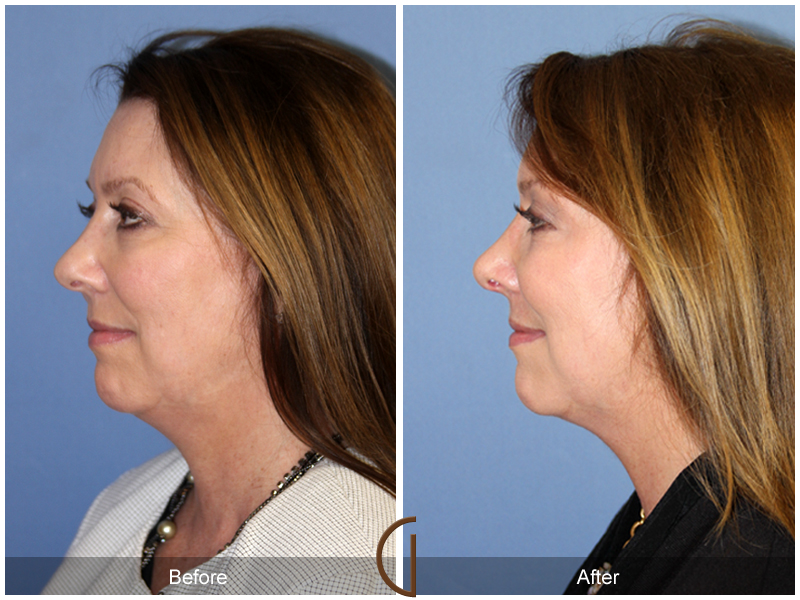 Female Rhinoplasty Before & After Image