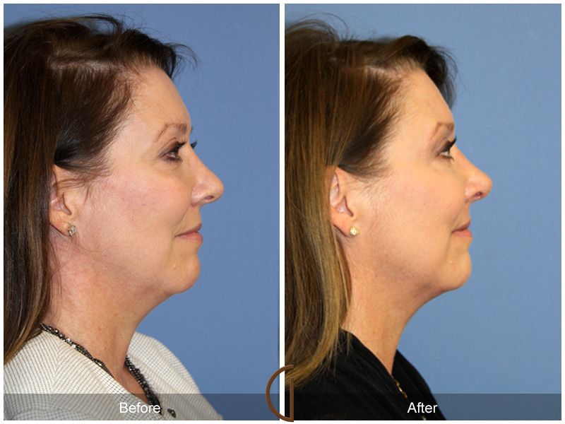 Female Rhinoplasty Before & After Image