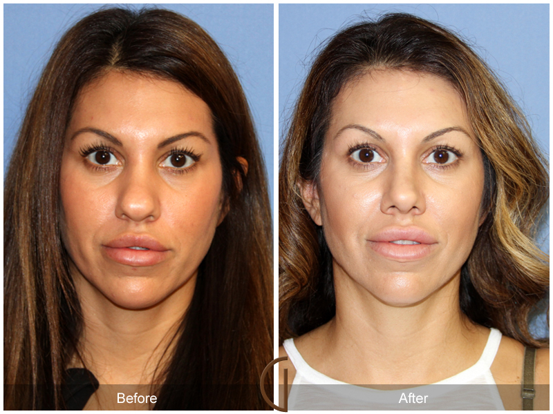 Female Rhinoplasty Before & After Image