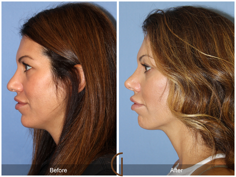 Female Rhinoplasty Before & After Image