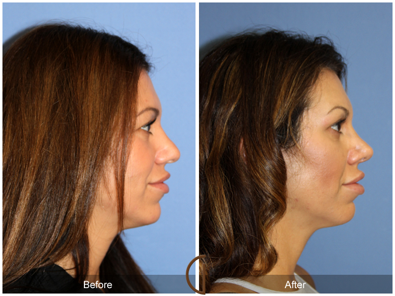 Female Rhinoplasty Before & After Image