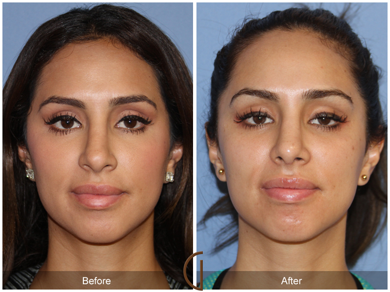 Female Rhinoplasty Before & After Image