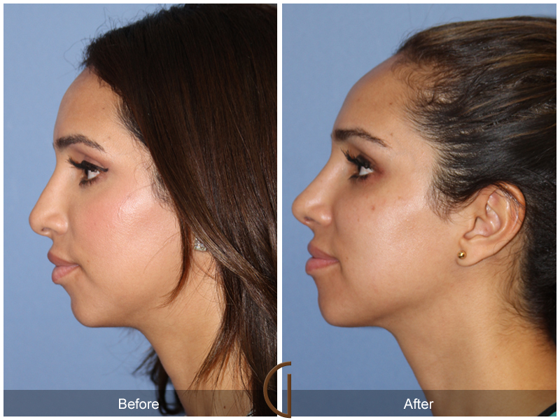 Female Rhinoplasty Before & After Image