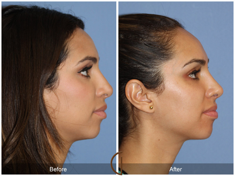 Female Rhinoplasty Before & After Image