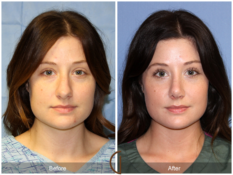 Female Rhinoplasty Before & After Image