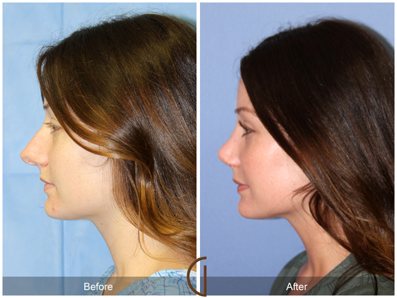 Female Rhinoplasty Before & After Image