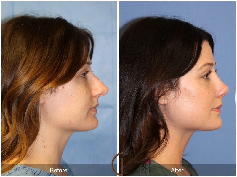 Female Rhinoplasty Before & After Image