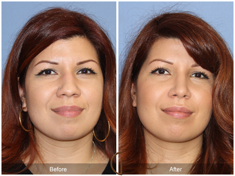 Female Rhinoplasty Before & After Image