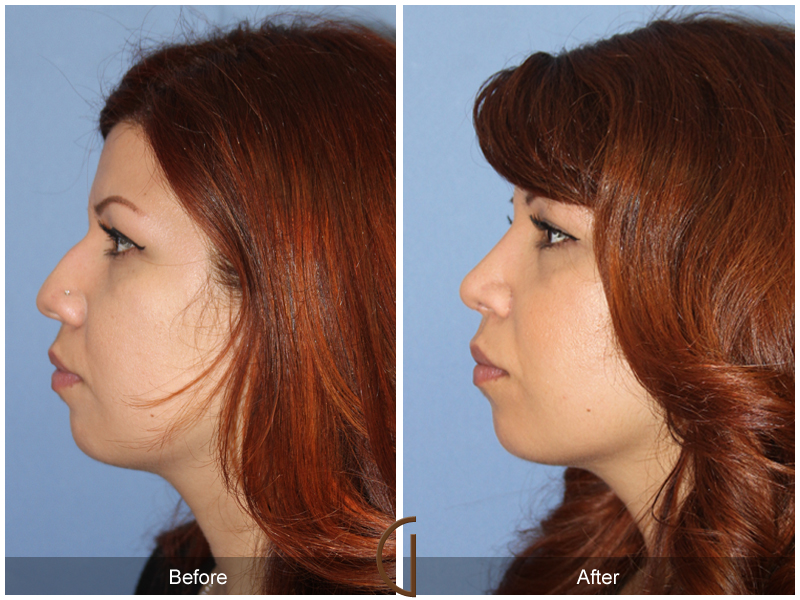 Female Rhinoplasty Before & After Image