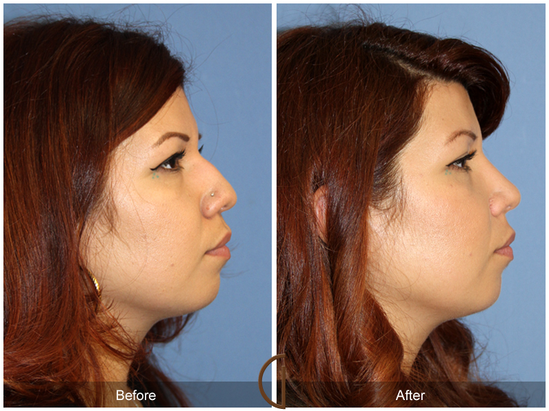 Female Rhinoplasty Before & After Image