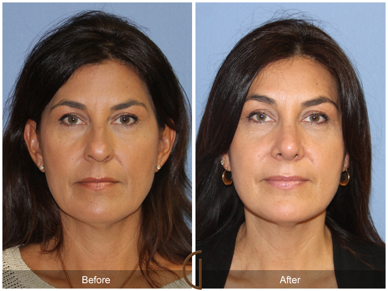 Female Rhinoplasty Before & After Image