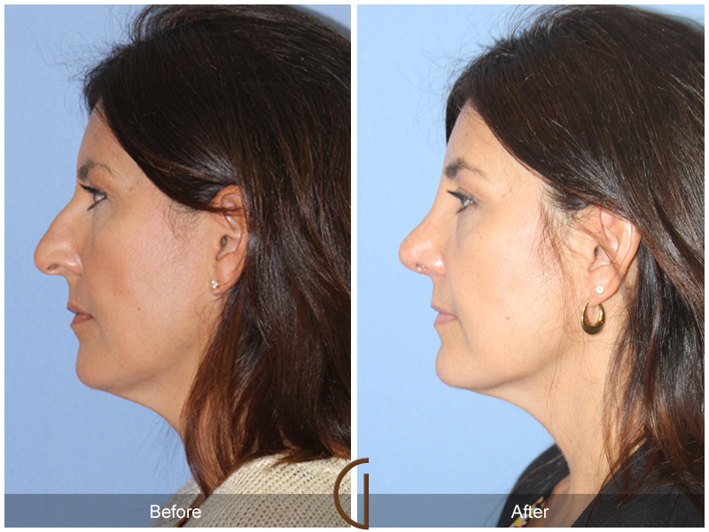 Female Rhinoplasty Before & After Image