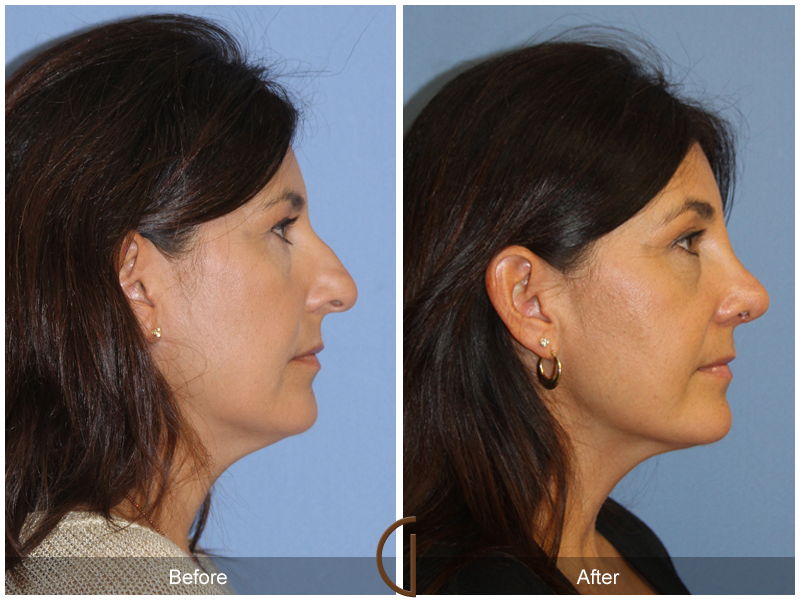 Female Rhinoplasty Before & After Image